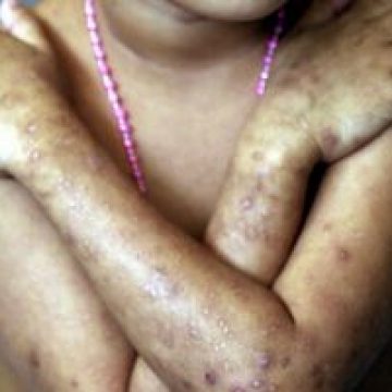 Infecţiile contractate în spitale afectează anual peste 6 milioane de pacienţi în Europa şi SUA (OMS)