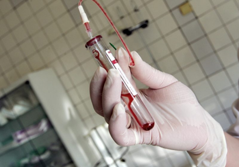 1000 de romani infectati cu virusul hepatitei C