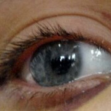 Riscul de deces se vede în privire, relevă un studiu Riscul de deces se vede în privire, relevă un studiu