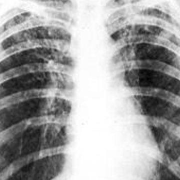 Un nou tratament combinat oferă speranţe noi în lupta contra tuberculozei Un nou tratament combinat oferă speranţe noi în lupta contra tuberculozei