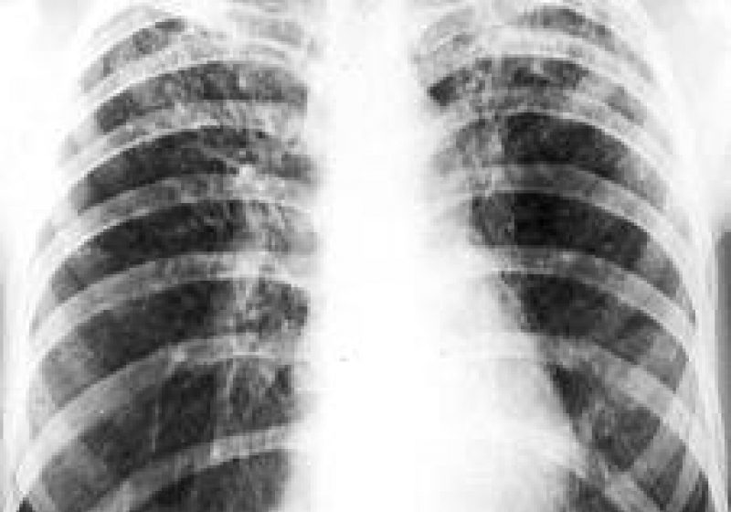 Un nou tratament combinat oferă speranţe noi în lupta contra tuberculozei