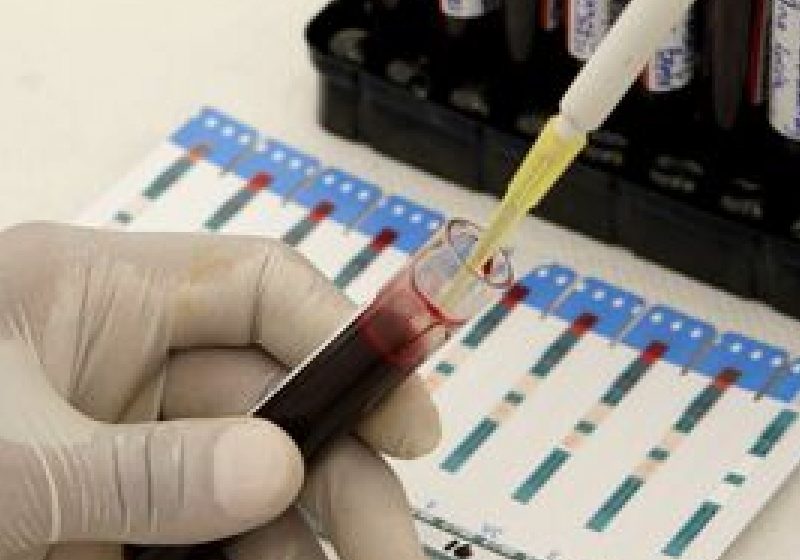În viitor infarctul ar putea fi prevăzut cu ajutorul unui test de sânge În viitor infarctul ar putea fi prevăzut cu ajutorul unui test de sânge