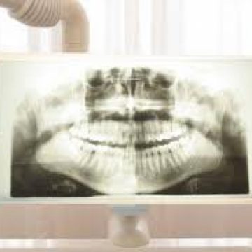 Radiografiile dentare pot cauza tumori cerebrale Radiografiile dentare pot cauza tumori cerebrale