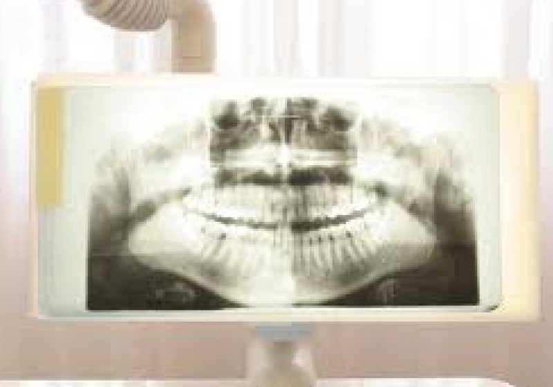 Radiografiile dentare pot cauza tumori cerebrale