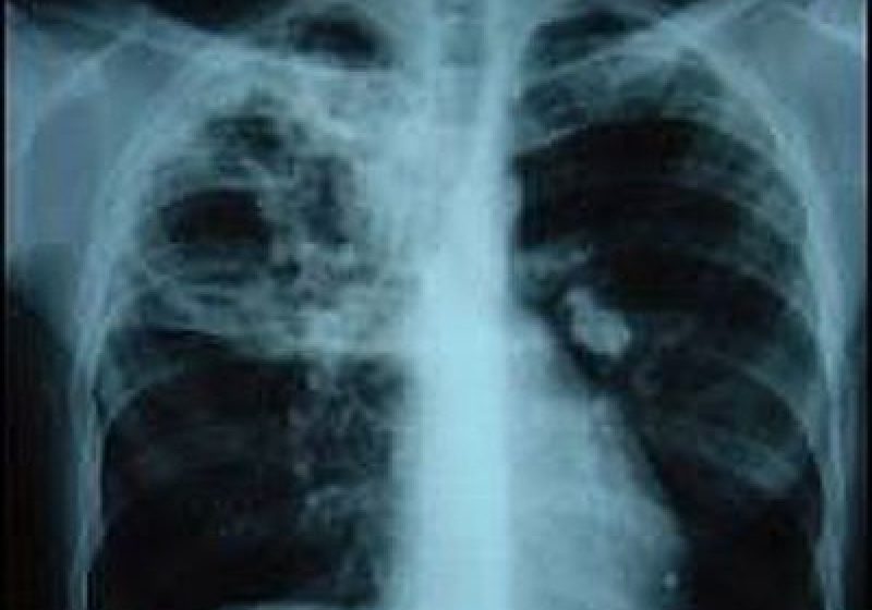 SIGHET: Incidenţa cazurilor de tuberculoză a scăzut în ultimul timp: în Sighet exită un singur caz de tuberculoză infantilă SIGHET: Incidenţa cazurilor de tuberculoză a scăzut în ultimul timp: în Sighet exită un singur caz de tuberculoză infantilă