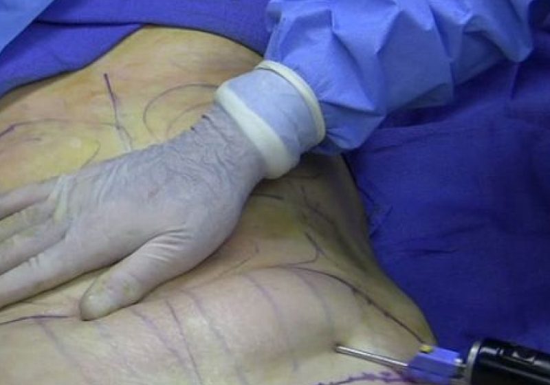 Femeia din Brăila care intrase în comă după o operaţie de liposucţie a murit