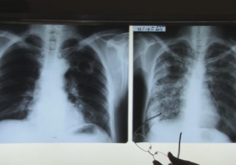 SIGHET: O dată cu apariţia unui nou val de viroze s-ar putea să apară şi noi cazuri de tuberculoză