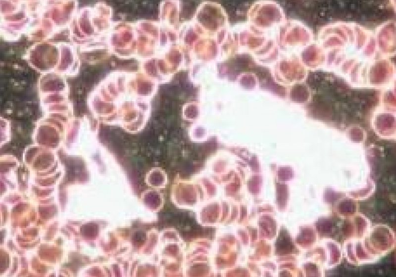 Oamenii de ştiinţă descoperă indicii cu privire la răspândirea cancerului în organism