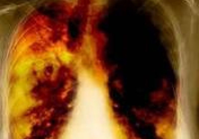 Un pachet de ţigări pe zi creşte de 20 de ori riscul de cancer pulmonar, potrivit unui expert