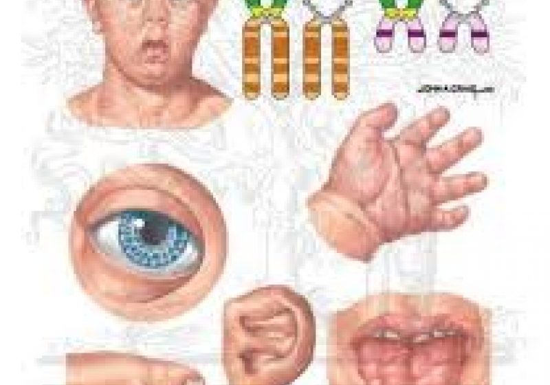 Geneticienii din ce în ce mai aproape de un tratament în cazul sindromului Down Geneticienii din ce în ce mai aproape de un tratament în cazul sindromului Down