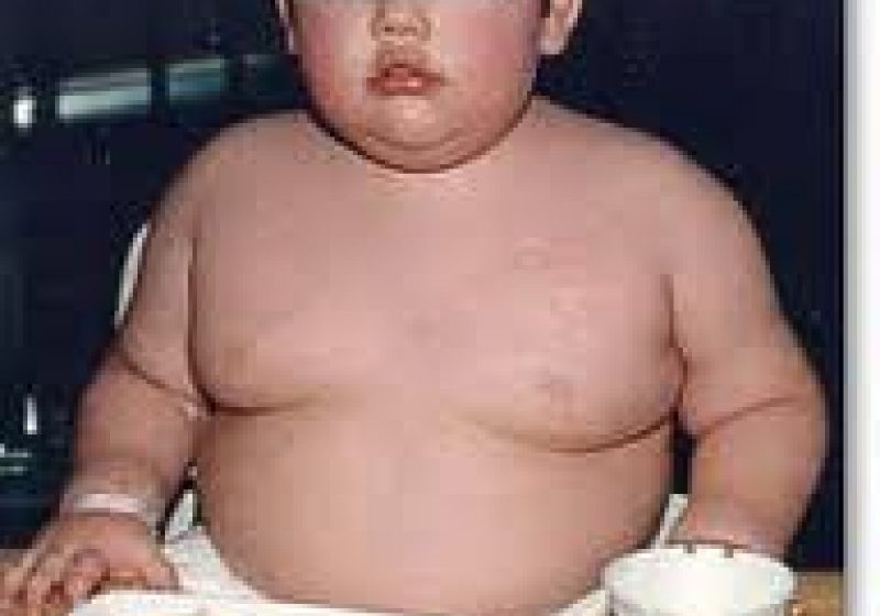 SOLUŢII: Chirurgia bariatrică ar putea fi o soluţie pentru rezolvarea obezităţii şi la copii SOLUŢII: Chirurgia bariatrică ar putea fi o soluţie pentru rezolvarea obezităţii şi la copii