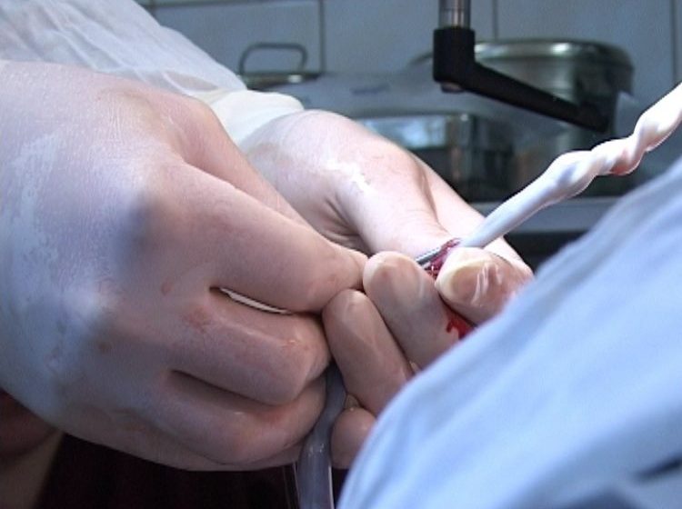 STUDIU: Transfuzia cu celule stem recoltate la naştere, şansă pentru copiii cu paralizie cerebrală spastică STUDIU: Transfuzia cu celule stem recoltate la naştere, şansă pentru copiii cu paralizie cerebrală spastică
