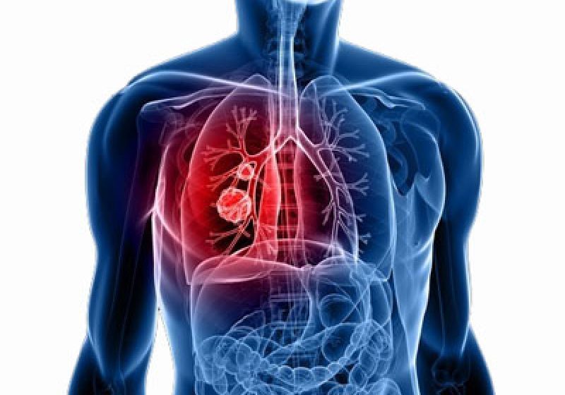 STUDIU: Primele semne ale cancerului pulmonar ar putea fi detectate cu ajutorul unui test respirator STUDIU: Primele semne ale cancerului pulmonar ar putea fi detectate cu ajutorul unui test respirator