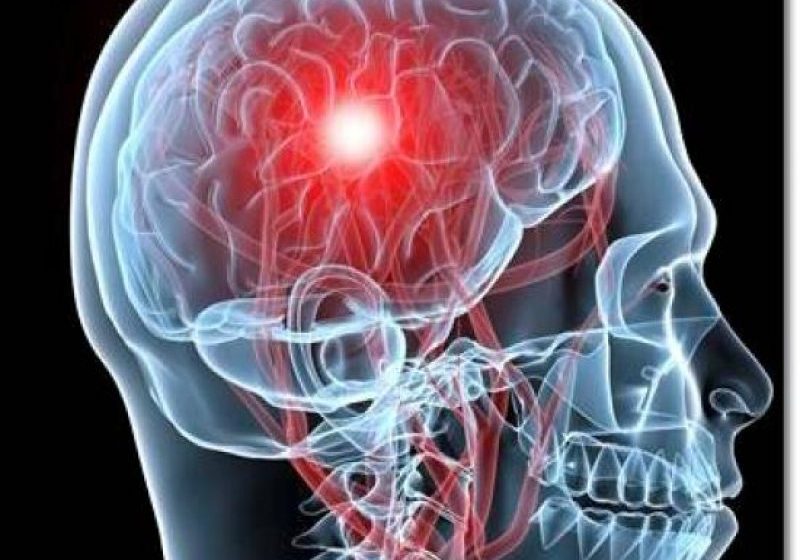 STUDIU: Furtunile geomagnetice ar putea influenţa riscul de accident vascular cerebral