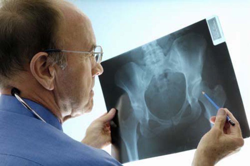 20 OCTOMBRIE: Ziua mondială a osteoporozei 20 OCTOMBRIE: Ziua mondială a osteoporozei