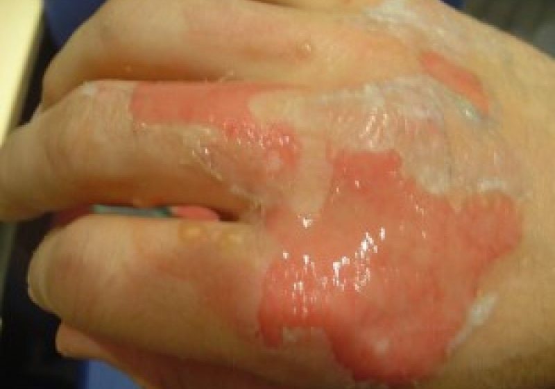 REPORTAJUL ZILEI: Arsurile, periculoase şi când par leziuni minore. Vezi ce spun medicii