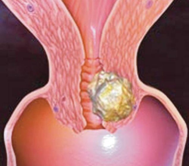 ALARMANT: La cabinetele medicilor de familie din Maramureş nu se desfăşoară nicio campanie de prevenire a cancerului de col uterin