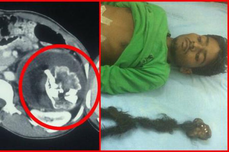 INDIA: Un fetus de 2,5 kilograme a fost scos din abdomenul unui adolescent INDIA: Un fetus de 2,5 kilograme a fost scos din abdomenul unui adolescent