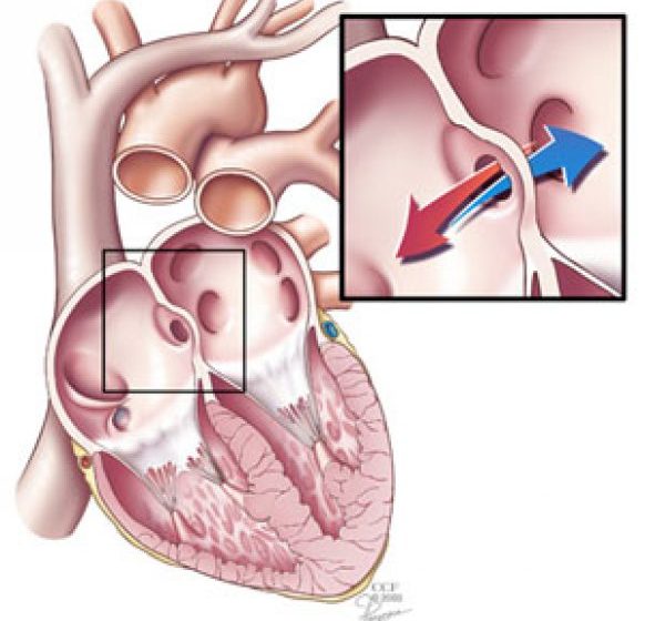 DEFECTUL SEPTAL: Cea mai frecventă malformaţie cardiacă pe care mulţi oameni nu ştiu că o au