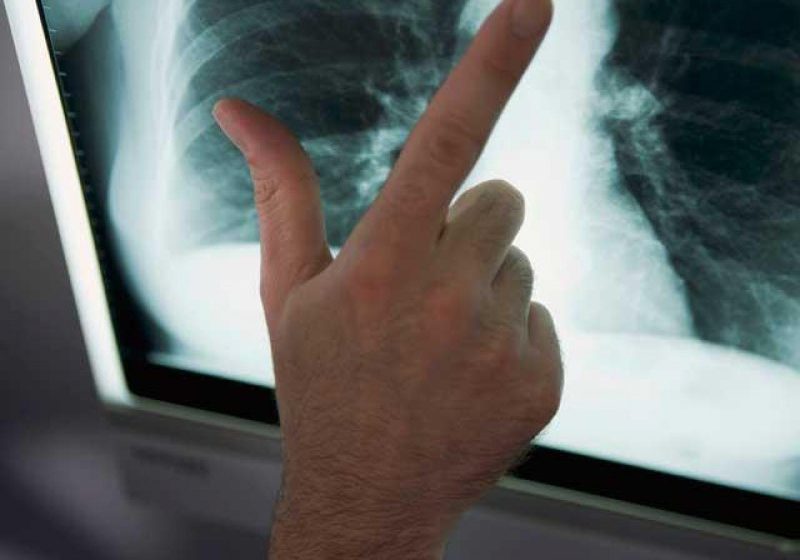 ALARMANT: Eforturile la nivel mondial împotriva tuberculozei sunt insuficiente