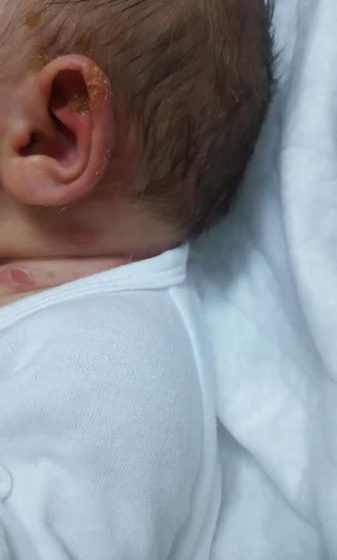 ANCHETĂ EPIDEMIOLOGICĂ LA SPITALUL JUDEȚEAN: Doi nou-născuţi infectaţi cu stafilococ