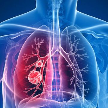 VIDEO | Vom avea un medicament contra cancerului pulmonar