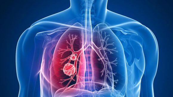 VIDEO | Vom avea un medicament contra cancerului pulmonar VIDEO | Vom avea un medicament contra cancerului pulmonar