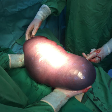 Splină de 6,5 kilograme, operată la Spitalul Județean din Baia Mare Splină de 6,5 kilograme, operată la Spitalul Județean din Baia Mare