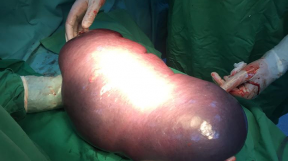 Splină de 6,5 kilograme, operată la Spitalul Județean din Baia Mare