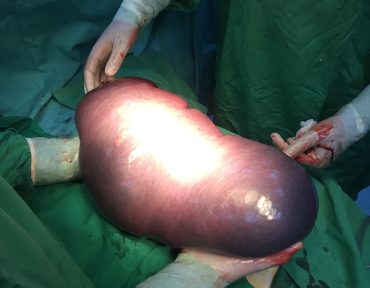 Splină de 6,5 kilograme, operată la Spitalul Județean din Baia Mare
